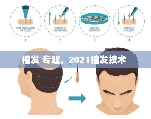植发 专题，2021植发技术 